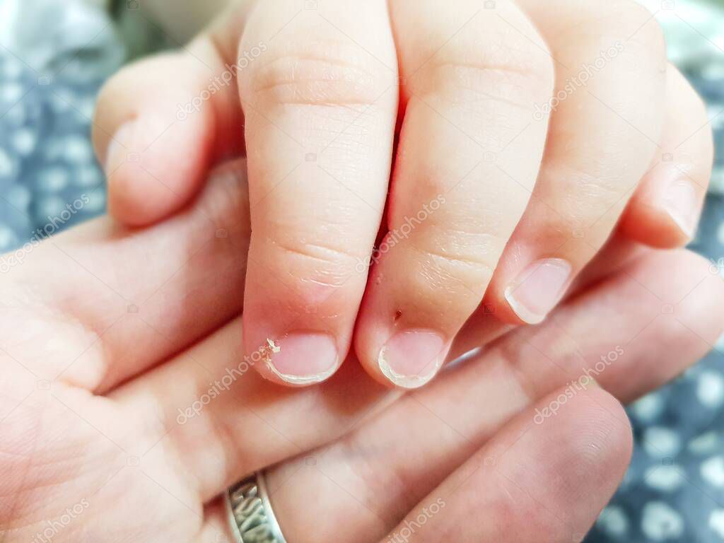 Childrens long unkempt flaking nails with burrs close-up.