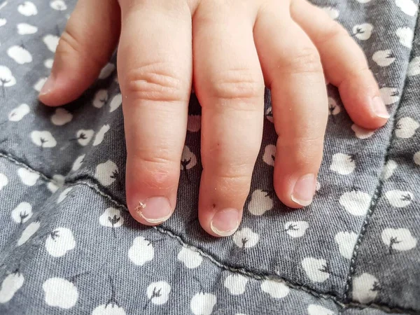 Crianças longo unkempt descamação unhas com rebarbas close-up . — Fotografia de Stock
