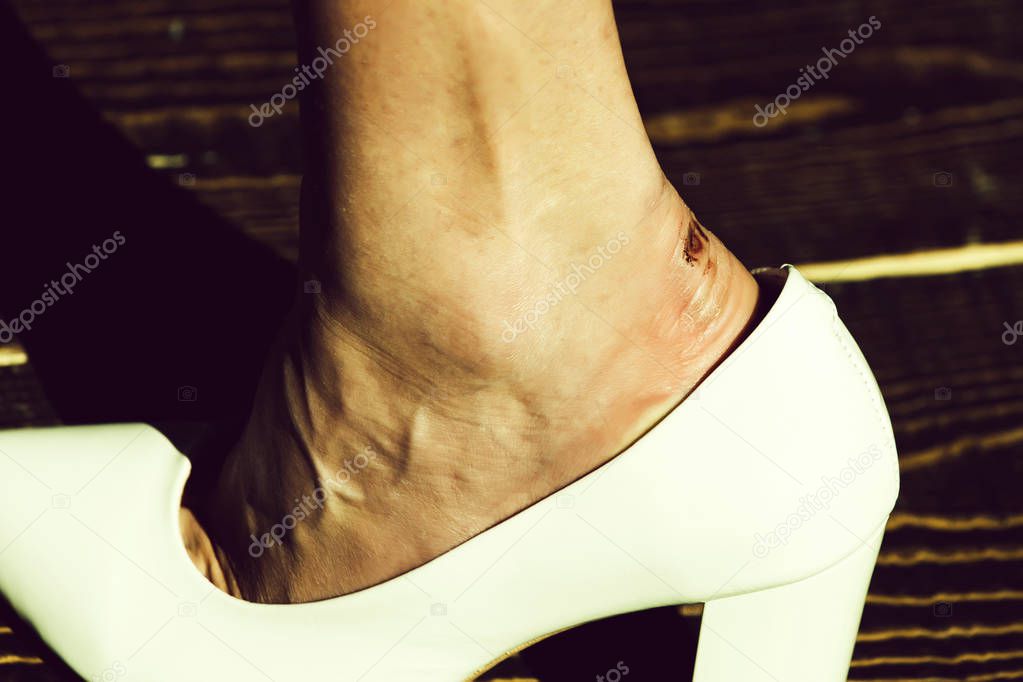 plasters for feet. wound on foot in white fashionable shoe of glamour woman