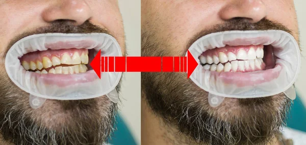 Smile before and after bleaching. Dental care and whitening teeth. Result of teeth whitening. Teeth Whitening Before After. Yollow or white teeth.