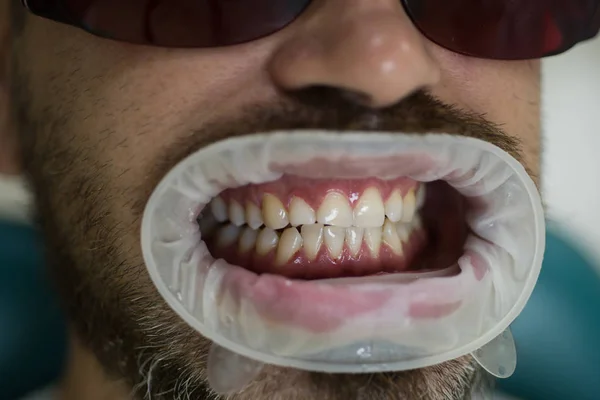 Blanchiment des dents à la clinique dentaire. Administrez des anesthésiques pour éviter aux patients de ressentir de la douleur pendant les procédures. Comparaison après blanchiment des dents. Blanchiment des dents . — Photo