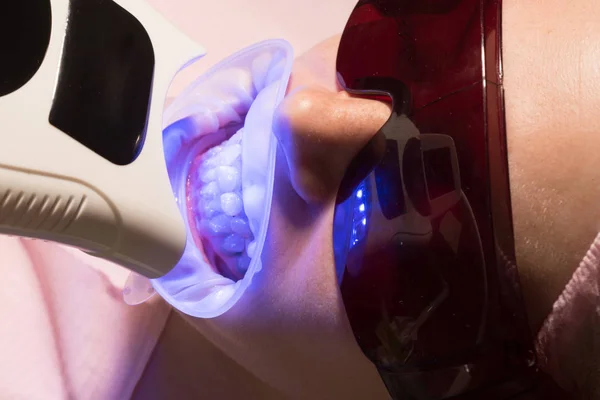 Vitare tänder. Leende stomatologi och leende tand. Förlägger fogmassa eller blekmedel på tänderna. Tandblekning förfarande med ultraviolett ljus UV-lampa. — Stockfoto