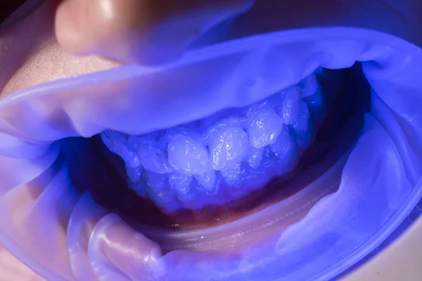 Blanchiment UV des dents. Administrez des anesthésiques pour éviter aux patients de ressentir de la douleur pendant les procédures. Remplissage des dents lampe ultraviolette. Comparaison après blanchiment des dents . — Photo