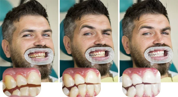 Homme isolé sur dents blanches : avant et après concept. Concept de stomatologie - gros plan du dentiste féminin avec les dents du patient masculin. Dents blanches ou jaunes . — Photo