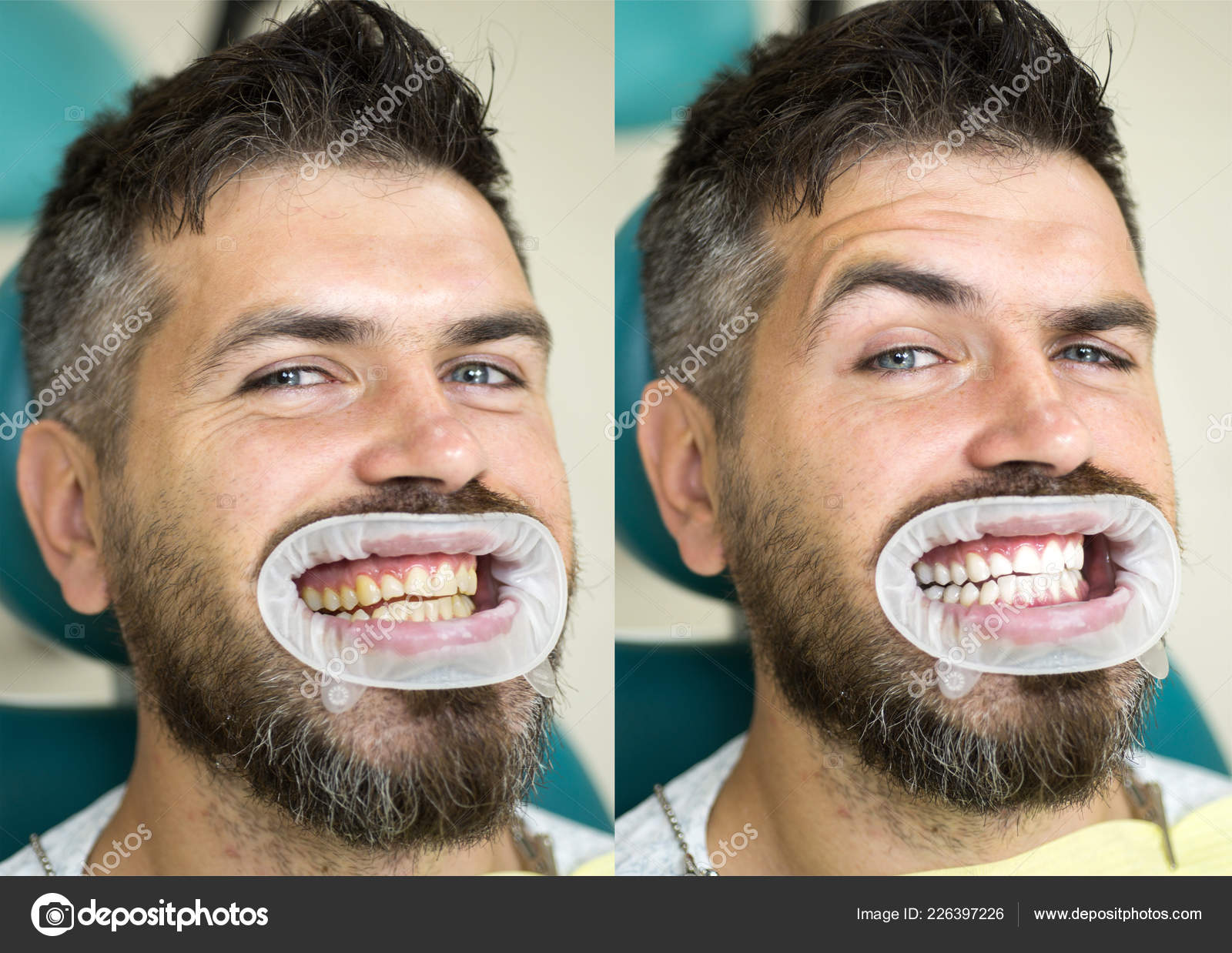 White Teeth Before And After Concept Close Up Detail Of Man