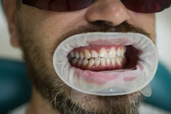 Retrato de hombre con dientes blancos como la nieve. Dentista examinando los dientes de los pacientes en la clínica . — Foto de Stock