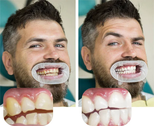 Whitening after and before. Man in dental chair. Dentist preparing for dental whitening. Health medicine people dentistry doctor curing. Result of teeth whitening.