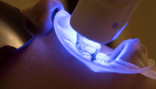 Close-up portret van een vrouwelijke patiënt bij de tandarts in de kliniek. Set van implantaten met verschillende tinten van Toon. Overeenkomen met de kleuren van de implantaten of het proces van tanden whitening. — Stockfoto
