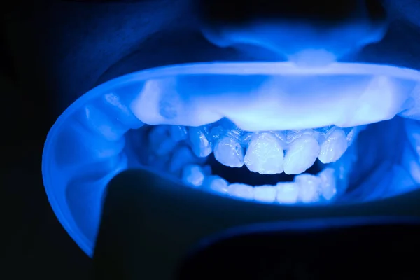 Vrouwelijke patiënt bij de tandarts in de kliniek. Mensen, geneeskunde, Afdeling Stomatologie en gezondheidszorg concept - close up van vrouwelijke tandarts met tandheelkundige spiegel controle mannelijke patiënt tanden op het kantoor van de tandheelkundige kliniek. — Stockfoto