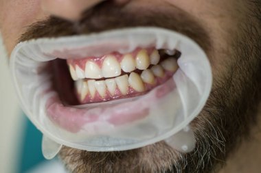 Genç adam diş hekimi, diş rengini seçme. Kadın dişçi ile modern diş kliniği aynada hasta diş kontrol. Kar beyaz dişler ile neşeli erkek kişi portresi.