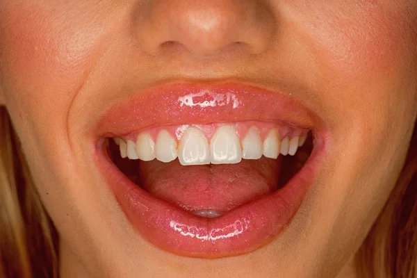 Посміхайся широко. Стоматологічна допомога. Сексуальні губи сексуальної жінки. Сексуальна жінка з білою посмішкою. Силіконові ін'єкції для губ. Силіконові зубні дужки. Ботокс лікування. Ботокс і наповнювач. Макіяж такий трансформаційний — стокове фото