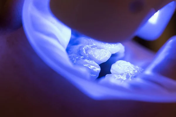 Belle jeune femme avec des dents saines sur fond blanc. Portrait de patient heureux dans une chaise dentaire. Technologie outils lampe ultraviolette . — Photo