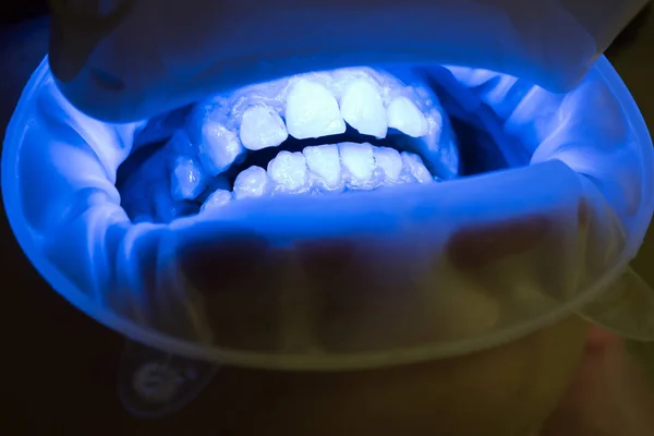 Primer plano de la boca femenina. Igualar los tonos de los implantes o el proceso de blanqueamiento dental. Dentista con un asistente en uniforme desechable en una clínica dental moderna . — Foto de Stock