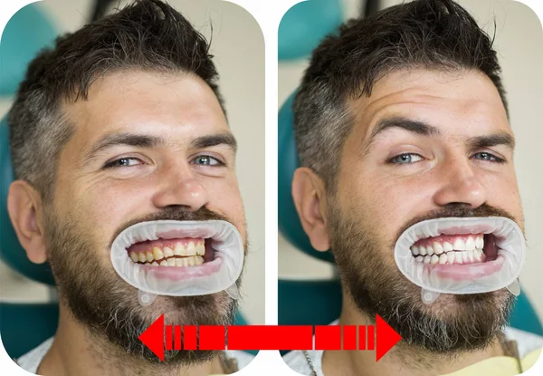 Dents jaunes vs blanches, avant ou après le blanchiment. Homme avec un fond isolé touchant la bouche avec une expression douloureuse en raison de maux de dents ou de maladies dentaires sur les dents. Détail en gros plan des dents d'homme — Photo