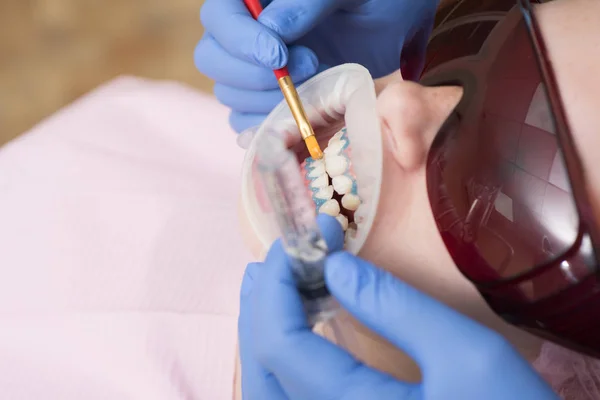 Blanchiment des dents au laser. Les gens, la médecine, la stomatologie et le concept de soins de santé - gros plan d'une dentiste avec miroir dentaire vérifiant les dents des patients masculins au cabinet de la clinique dentaire . — Photo