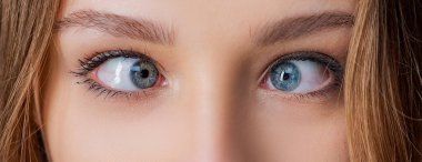 Gözler, Erkek yüzünde gözlerini kısarak görünüm ve kaş ile. Kadın gözleri şaşılık ile. Hipertropya. Kadın gözleri şaşılık muzdarip-yakın yukarı.