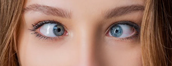 Olhos com olhar espremido e sobrancelhas no rosto masculino. Olhos femininos com estrabismo. Hipertropia. Olhos de mulher que sofrem de estrabismo - close-up . — Fotografia de Stock