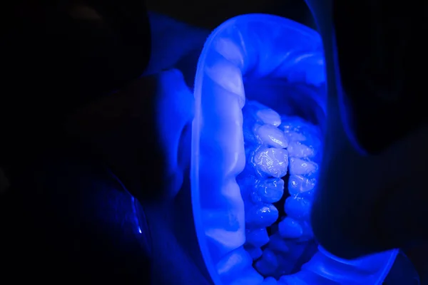 女性の口のクローズアップ。現代の歯科医院の使い捨てユニフォームの助手が付いている。歯のホワイトニング手順。歯の健康. — ストック写真