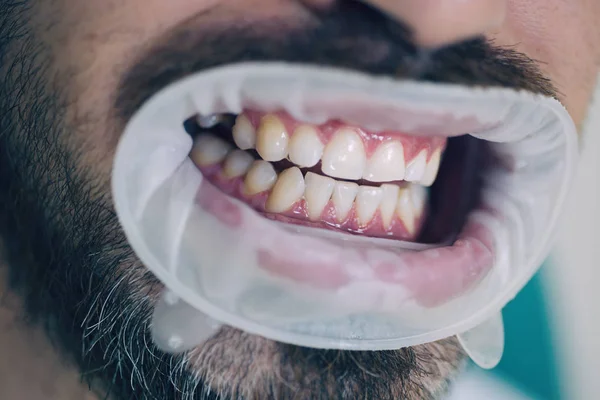 Joven hombre eligiendo el color de los dientes en el dentista. Dentista femenina revisando dientes de paciente con espejo en clínica dental moderna. Retrato de hombre alegre con dientes blancos como la nieve . — Foto de Stock