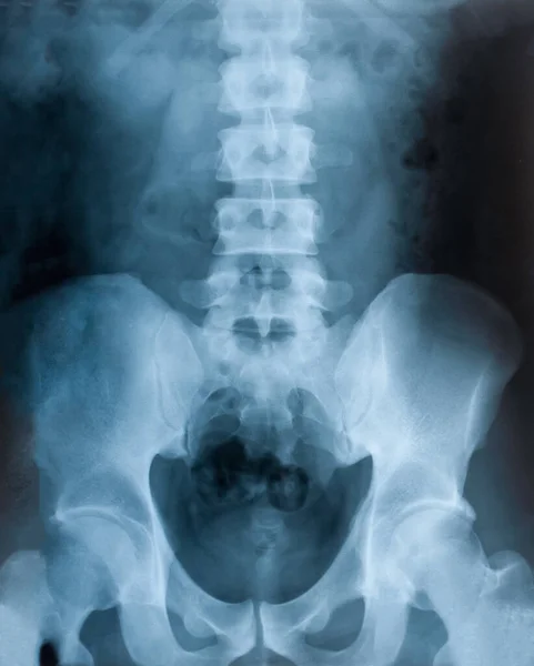 骨盤のX線フィルム 健康診断 ストック画像