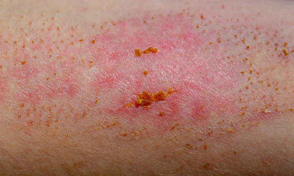 Deride yara. Grev kırıcı. Yarayı iyileştirir. Deri hastalıkları.