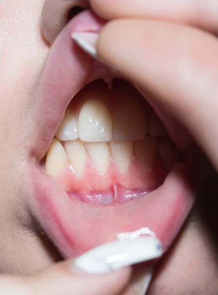 Dentes em boca aberta, menina abriu os lábios e mostra dentes brancos após clareamento dos dentes no dentista. Modelo são na moda e hálito fresco, beijo delicioso da beleza. Manicure e sorriso branco — Fotografia de Stock