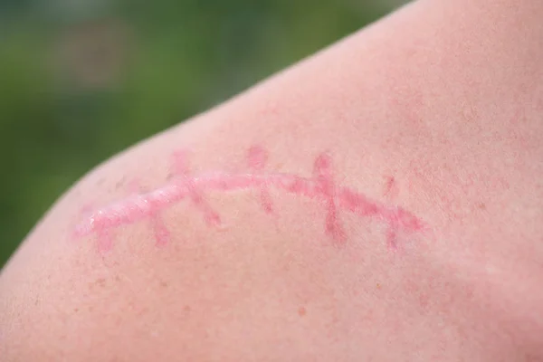 Scar. Skin wound. Plastic surgery. Scarification. White skin with a pink surgical scar on shoulder. Female shoulder and laser scar removal treatment.