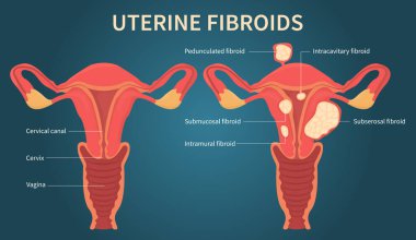 Koyu mavi arkaplanda rahim fibroidi şeması