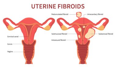 Kadın rahim fibroidleri beyaz zemin üzerinde diyagramı