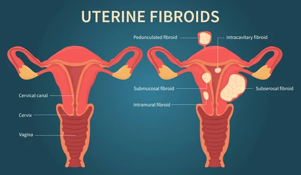 Esquema de fibromas uterinos sobre fondo azul oscuro — Archivo Imágenes Vectoriales