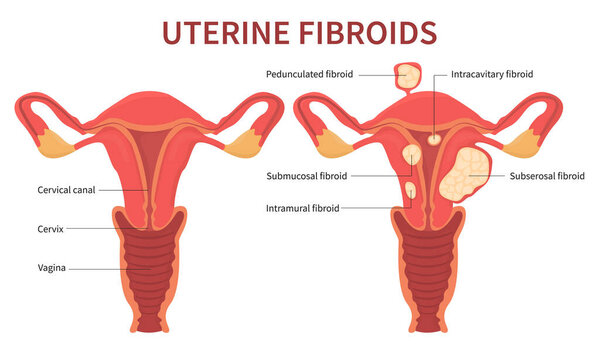 Woman uterine fibroids diagram on white background