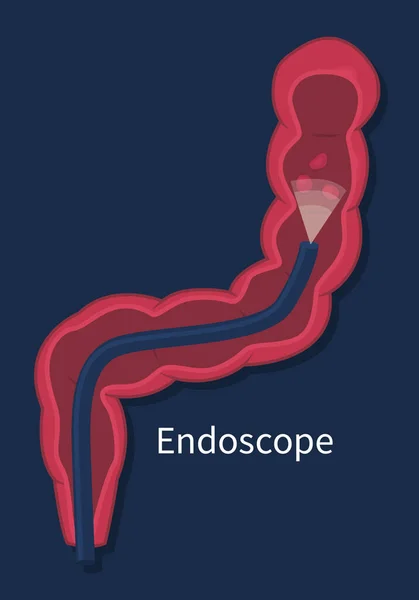 Endoskop im Dickdarm mit Polypen-Screening — Stockvektor