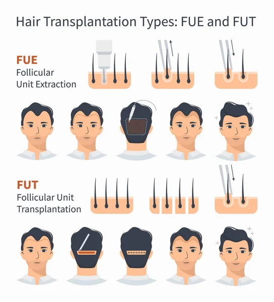 Tipi di trapianto di capelli FUE e FUT — Vettoriale Stock