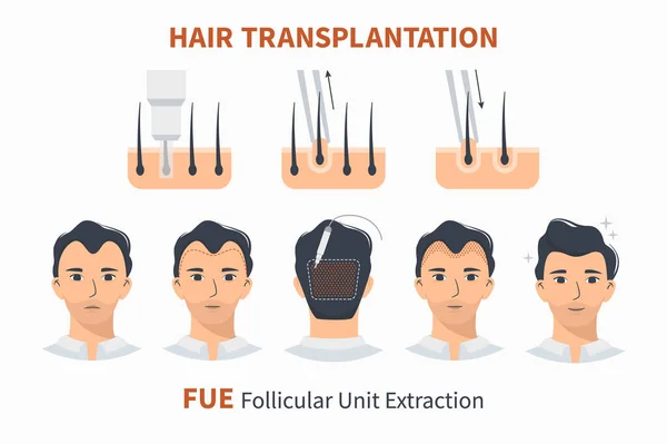 Tahapan transplantasi rambut FUE Unit Ekstraksi - Stok Vektor