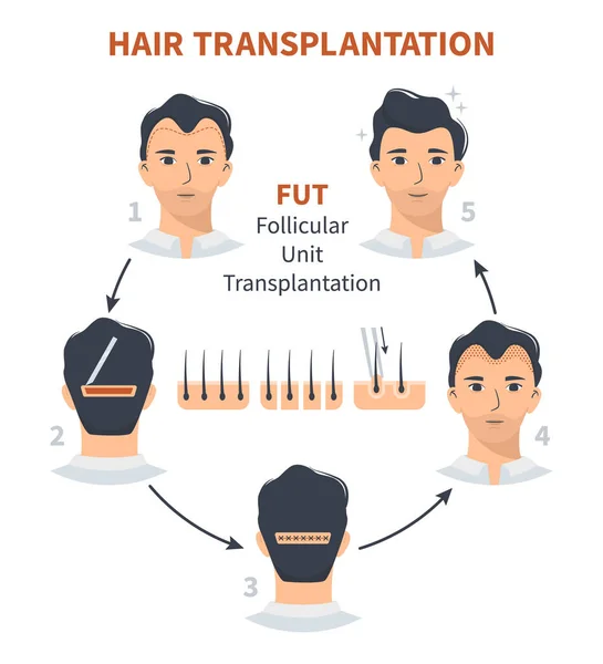 Etapper av hårtransplantation FUT Follikulär enhet — Stock vektor