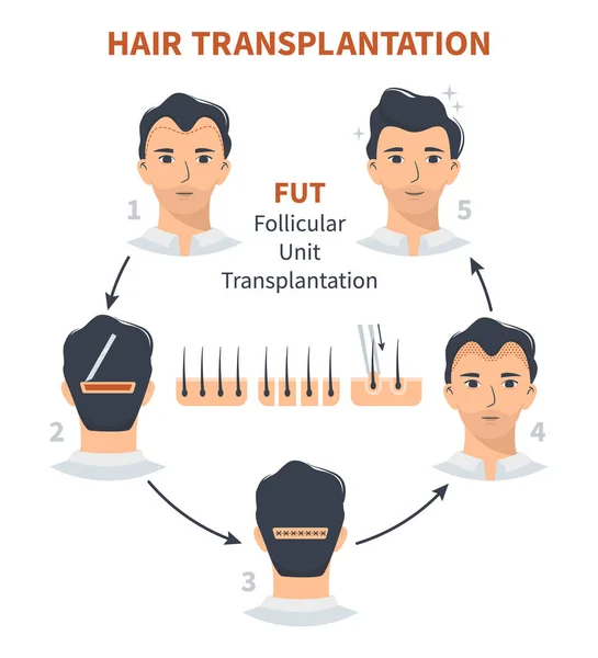 Estágios do transplante capilar Unidade Folicular FUT —  Vetores de Stock