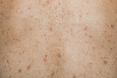 Arka tarafta sorunlu cilt ve akne izleri çocukla