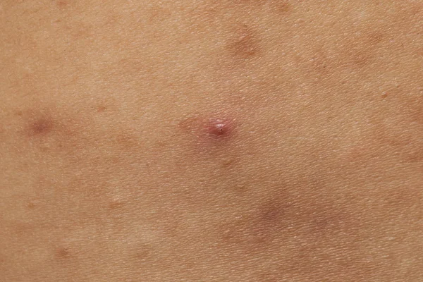 Jongen met problematische huid en acne littekens in de rug — Stockfoto