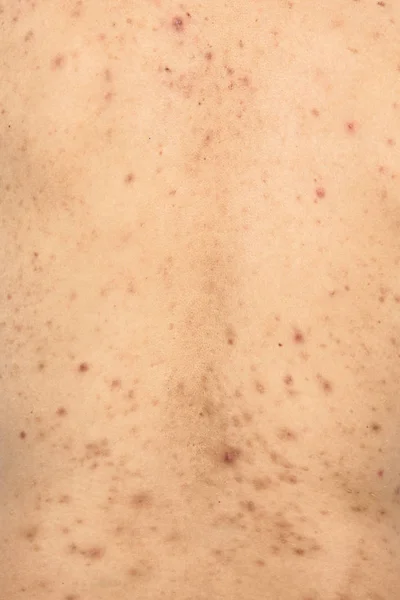 Jongen met problematische huid en acne littekens in de rug — Stockfoto