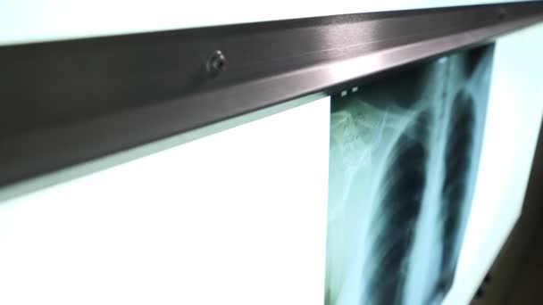 Esame Radiografico Fluagrofia Medicina — Video Stock