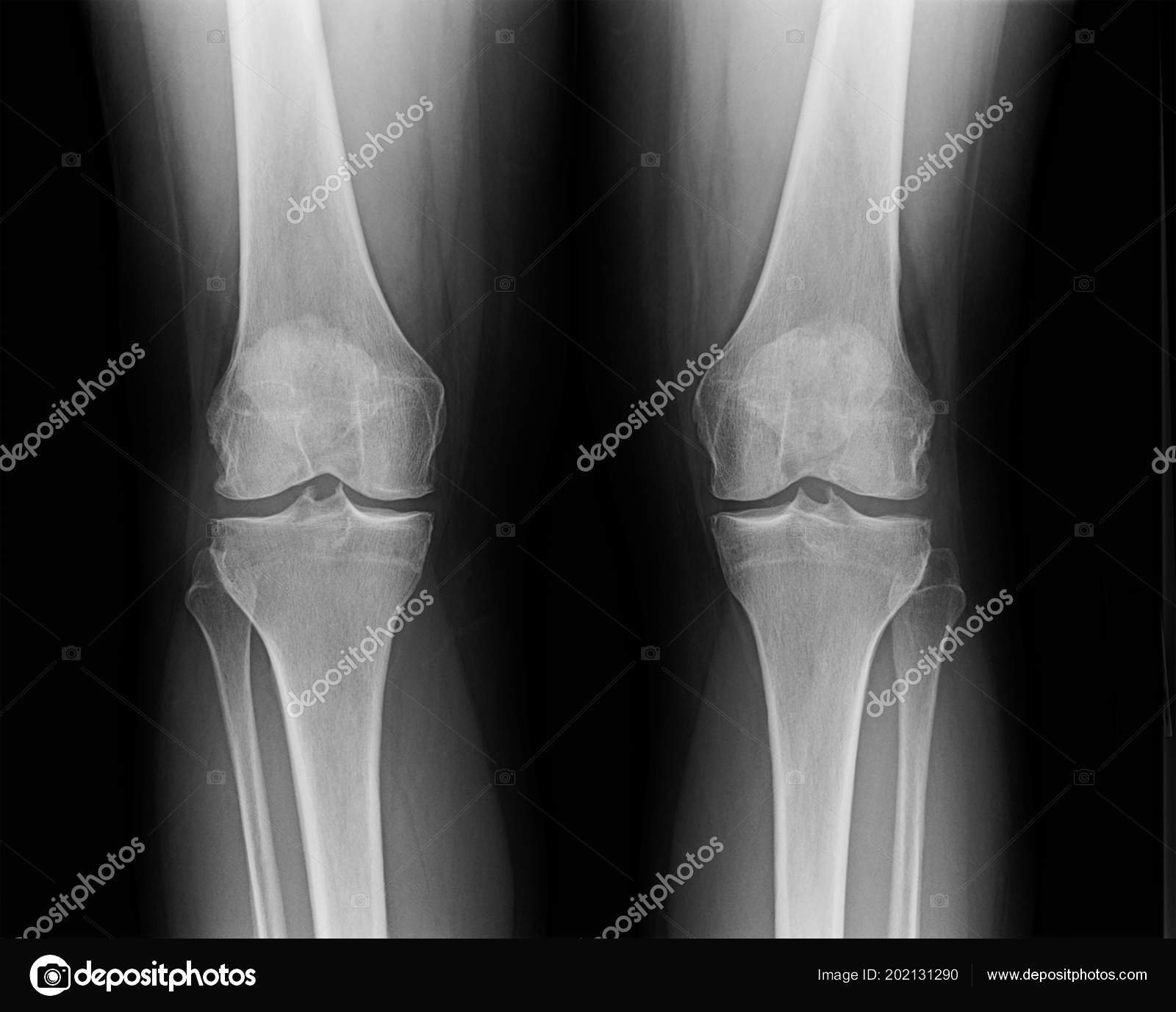 Ray Knees Mature Female Suffering Minor Osteoarthritis Bone Spurs Stock