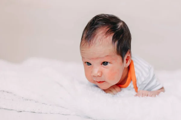 Neugeborener Junge Oder Mädchen Hautallergie Auf Dem Bett Liegend — Stockfoto
