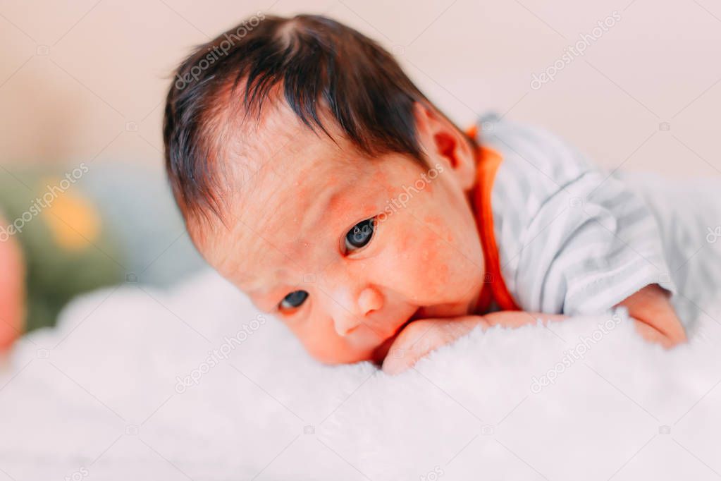 newborn baby boy or girl skin allergy lying on bed