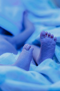 Yüksek bilirubin ile yeni doğan bir bebek mavi bir lamba altında yatıyor fototerapi