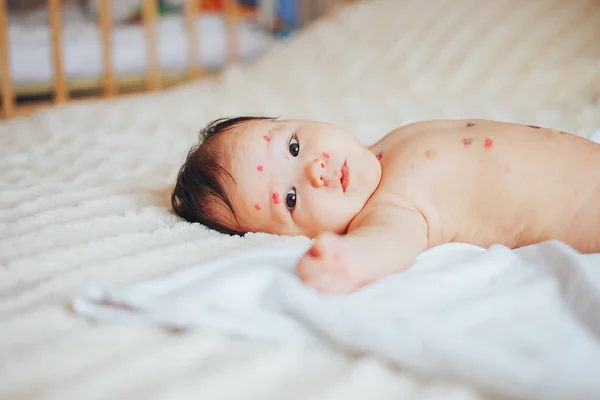 Primo Piano Una Ragazzina Carina Asiatico Ragazza Varicella Virus Varicella — Foto Stock