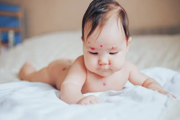 Close Naked Body Child Pimples Chicken Pox Pimples Body Child — Stock Photo, Image