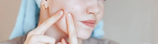 Teenage girl squeezing her pimples, removing pimple from her face. Woman skin care concept photos of ugly problem skin girl on beige background. — Stock Photo, Image