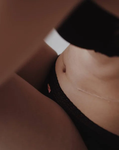 有疤痕的女人腹部 — 图库照片