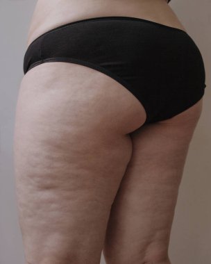 Kadının kalçaları rötuşsuz.