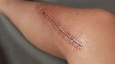 Healing surgical wound covered with medical stitches and bandage on a human leg. High quality 4k footage